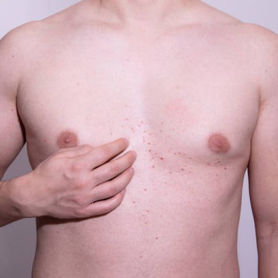 Gynecomastia Surgery in Riyadh