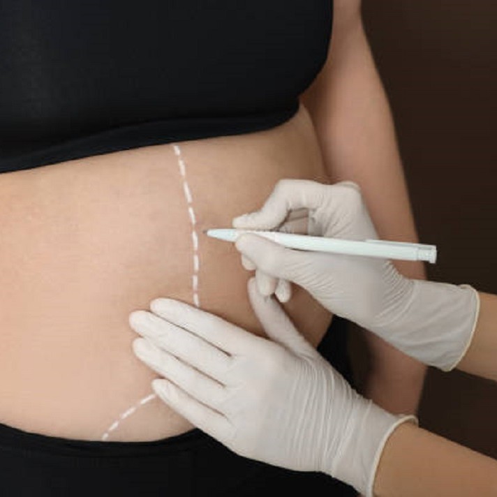 Liposuction in Riyadh
