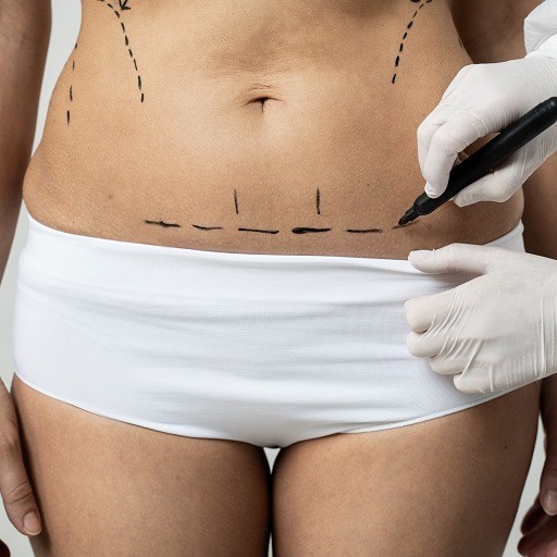 Laser liposuction in Riyadh